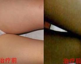 髂靜脈壓迫綜合徵 髂靜脈壓迫綜合徵