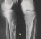 骨化性纖維瘤 骨化性纖維瘤