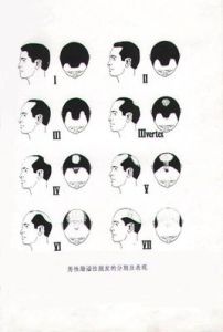 油脂性脫髮 油脂性脫髮