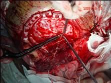 咽喉惡性腫瘤 咽喉惡性腫瘤