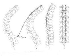 胸腰段及腰椎前凸消失 胸腰段及腰椎前凸消失