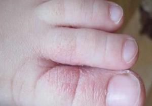 糜爛性腳氣 糜爛性腳氣