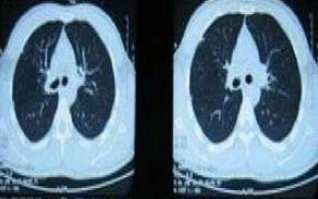 結核菌素試驗 結核菌素試驗