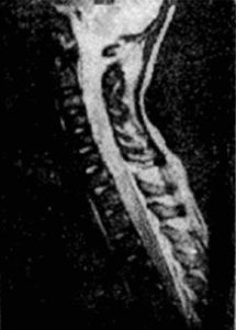 脊髓挫傷 脊髓挫傷