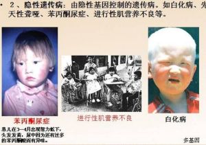 遺傳疾病 遺傳疾病