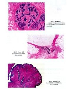 結節性筋膜炎 結節性筋膜炎