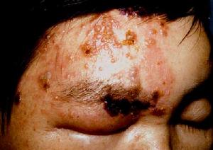 單純皰疹性葡萄膜炎