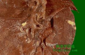 免疫缺陷性肺炎