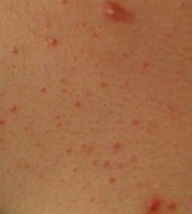 背部長痘 背部長痘