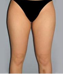 腿部吸脂手術 腿部吸脂手術
