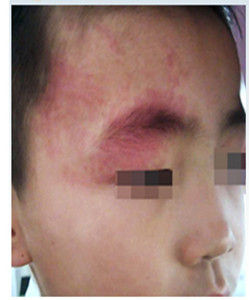 鮮紅斑痣 鮮紅斑痣