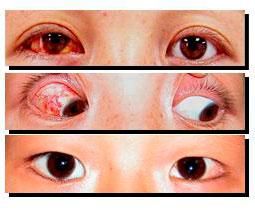 眼球後退綜合徵 眼球後退綜合徵