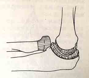 肘關節成形術 肘關節成形術