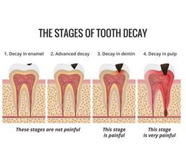 齲齒[預防方法]