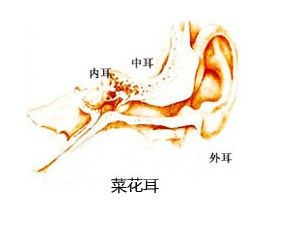 菜花耳矯正術 菜花耳矯正術