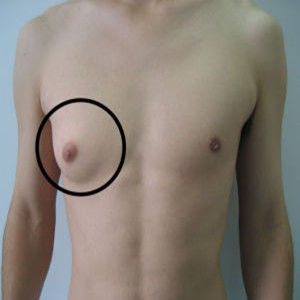 男性乳房肥大症 男性乳房肥大症