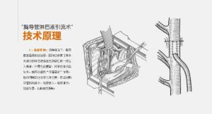 胸導管淋巴液引流技術