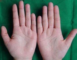 手心出汗 手心出汗