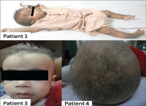 Menkes氏綜合徵 Menkes氏綜合徵