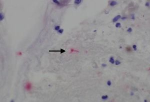 晚期梅毒洗劑 晚期梅毒洗劑