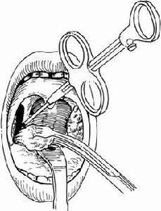 扁桃體周圍膿腫切開術 扁桃體周圍膿腫切開術