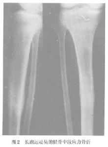 脛骨應力骨折 脛骨應力骨折