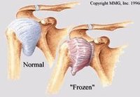 心臟破裂生理表現