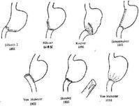 胃大部切除術 胃大部切除術