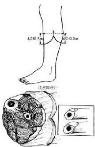小腿截體術 小腿截體術