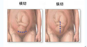 剖宮產