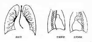 肺動脈口狹窄