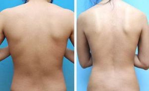 背部吸脂 背部吸脂