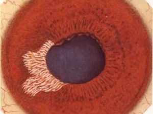 異色性虹膜睫狀體炎 異色性虹膜睫狀體炎