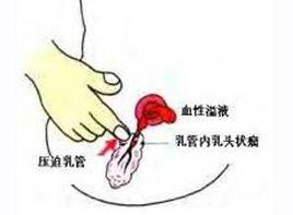 乳暈深部可捫及腫塊 乳暈深部可捫及腫塊