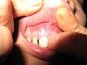 根尖膿腫 根尖膿腫