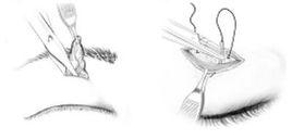 縫雙眼皮 縫雙眼皮