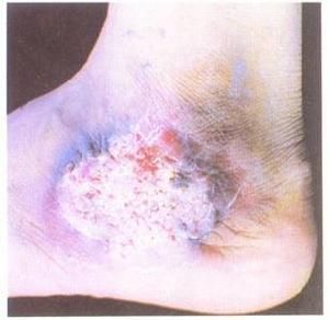 著色芽生菌病 著色芽生菌病