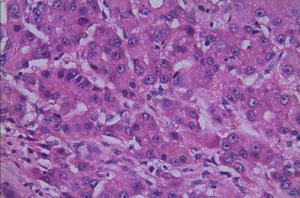 肝細胞性肝癌 肝細胞性肝癌