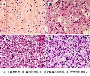 顱內低壓綜合徵