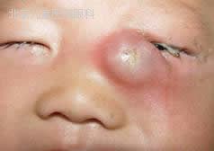 急性淋巴細胞白血病