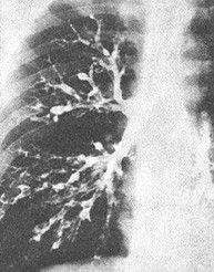肺紋理增多