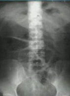 麻痹性腸梗阻 麻痹性腸梗阻