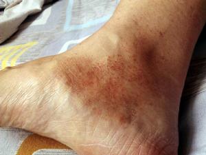 過敏性紫癜的治療 過敏性紫癜的治療