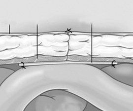 小兒疝氣微創手術 小兒疝氣微創手術