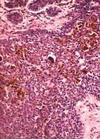 （圖）膀胱鱗狀細胞癌