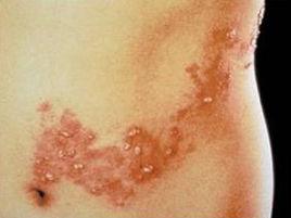 人皰疹病毒-6型感染 人皰疹病毒-6型感染