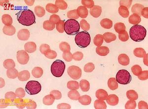 急性淋巴細胞白血病 骨髓象