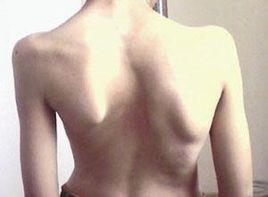 少兒脊柱側凸 少兒脊柱側凸