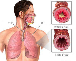 哮喘病人的支氣管