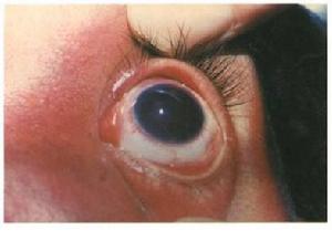 腦三叉神經血管瘤病